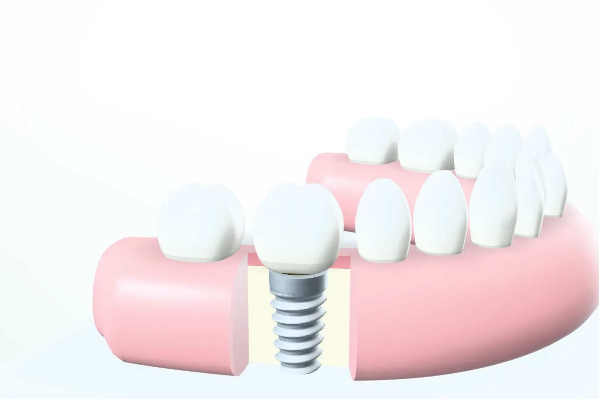 A cutaway of the jaw model showing a titanium implant in the bone, with its abutment and crown